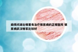 麻煩問(wèn)湖北哪里有治療銀屑病的正規(guī)醫(yī)院 銀屑病武漢哪家比較好