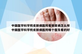 中國醫(yī)學(xué)科學(xué)院皮膚病醫(yī)院看銀屑病怎么樣 中國醫(yī)學(xué)科學(xué)院皮膚病醫(yī)院哪個醫(yī)生看的好