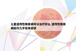 兒童遺傳性銀屑病可以治療好么 遺傳性銀屑病后代幾歲后有癥狀