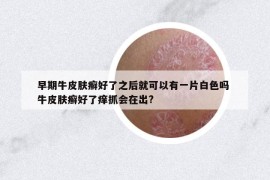 早期牛皮膚癬好了之后就可以有一片白色嗎 牛皮膚癬好了癢抓會在出?