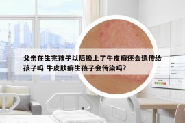 父親在生完孩子以后換上了牛皮癬還會(huì)遺傳給孩子嗎 牛皮膚癬生孩子會(huì)傳染嗎?