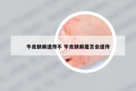 牛皮膚癬遺傳不 牛皮膚癬是否會遺傳