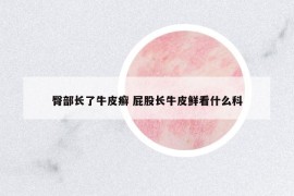 臀部長(zhǎng)了牛皮癬 屁股長(zhǎng)牛皮鮮看什么科