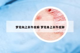 夢(mèng)見(jiàn)向上長(zhǎng)牛皮癬 夢(mèng)見(jiàn)身上長(zhǎng)牛皮鮮