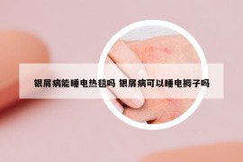 銀屑病能睡電熱毯嗎 銀屑病可以睡電褥子嗎