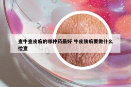 查牛查皮癬的哪種藥最好 牛皮膚癬要做什么檢查