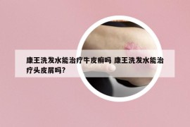 康王洗發(fā)水能治療牛皮癬嗎 康王洗發(fā)水能治療頭皮屑嗎?