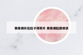 銀屑病長在肚子得照片 銀屑病肚臍癥狀