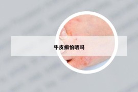 牛皮癬怕曬嗎