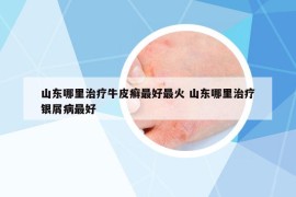 山東哪里治療牛皮癬最好最火 山東哪里治療銀屑病最好