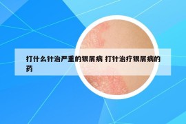 打什么針治嚴(yán)重的銀屑病 打針治療銀屑病的藥