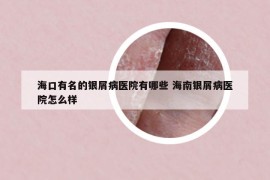 ?？谟忻你y屑病醫(yī)院有哪些 海南銀屑病醫(yī)院怎么樣
