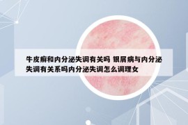 牛皮癬和內(nèi)分泌失調(diào)有關(guān)嗎 銀屑病與內(nèi)分泌失調(diào)有關(guān)系嗎內(nèi)分泌失調(diào)怎么調(diào)理女