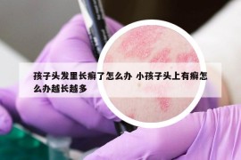 孩子頭發(fā)里長癬了怎么辦 小孩子頭上有癬怎么辦越長越多