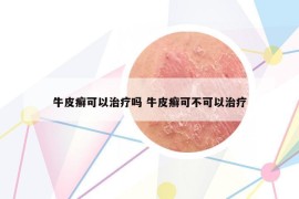 牛皮癬可以治療嗎 牛皮癬可不可以治療