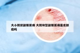 大小斑狀副銀屑病 大斑塊型副銀屑病是皮膚癌嗎