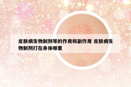 皮膚病生物制劑等的作用和副作用 皮膚病生物制劑打在身體哪里
