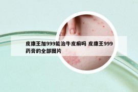 皮康王加999能治牛皮癬嗎 皮康王999藥膏的全部圖片