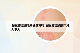 百癬夏塔熱排尿會發(fā)黃嗎 百癬夏塔熱副作用大不大