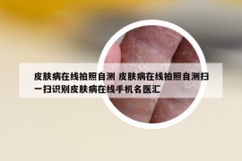 皮膚病在線拍照自測 皮膚病在線拍照自測掃一掃識別皮膚病在線手機(jī)名醫(yī)匯