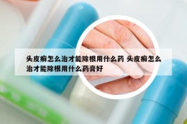 頭皮癬怎么治才能除根用什么藥 頭皮癬怎么治才能除根用什么藥膏好