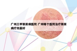 廣州三甲銀屑病醫(yī)院 廣州哪個醫(yī)院治療銀屑病療效最好