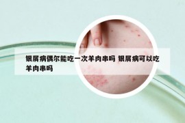 銀屑病偶爾能吃一次羊肉串嗎 銀屑病可以吃羊肉串嗎