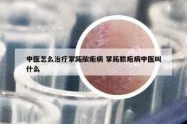中醫(yī)怎么治療掌跖膿皰病 掌跖膿皰病中醫(yī)叫什么