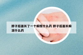 脖子后面長了一個(gè)癬擦什么藥 脖子后面長癬涂什么藥