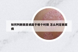 如何判斷銀屑病屬于哪個(gè)時(shí)期 怎么判定銀屑病