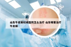 山東牛皮癬權(quán)威醫(yī)院怎么治療 山東哪里治療牛皮癬