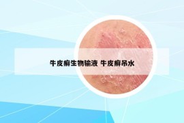 牛皮癬生物輸液 牛皮癬吊水