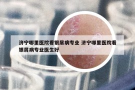 濟(jì)寧哪里醫(yī)院看銀屑病專業(yè) 濟(jì)寧哪里醫(yī)院看銀屑病專業(yè)醫(yī)生好