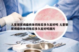 兒童銀屑病扁桃體切除后多久能好嗎 兒童銀屑病扁桃體切除后多久能好嗎圖片