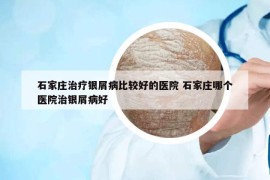 石家莊治療銀屑病比較好的醫(yī)院 石家莊哪個(gè)醫(yī)院治銀屑病好