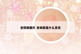 杏斑癬圖片 杏癍癬是什么意思