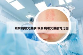 銀屑病跟艾滋病 銀屑病跟艾滋病對(duì)比圖