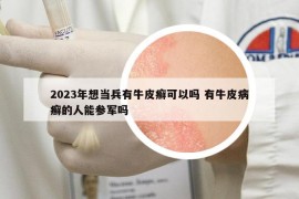 2023年想當(dāng)兵有牛皮癬可以嗎 有牛皮病癬的人能參軍嗎