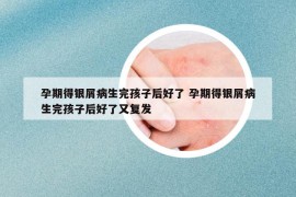 孕期得銀屑病生完孩子后好了 孕期得銀屑病生完孩子后好了又復(fù)發(fā)