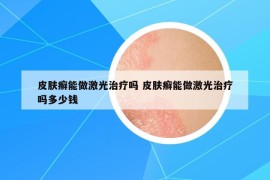 皮膚癬能做激光治療嗎 皮膚癬能做激光治療嗎多少錢