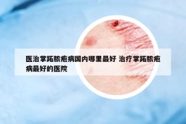 醫(yī)治掌跖膿皰病國內(nèi)哪里最好 治療掌跖膿皰病最好的醫(yī)院