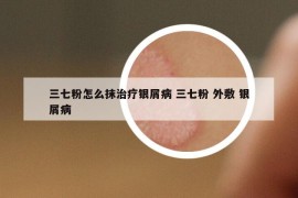 三七粉怎么抹治療銀屑病 三七粉 外敷 銀屑病