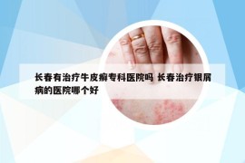 長春有治療牛皮癬?？漆t(yī)院嗎 長春治療銀屑病的醫(yī)院哪個好