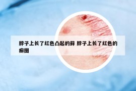 脖子上長(zhǎng)了紅色凸起的蘚 脖子上長(zhǎng)了紅色的癬圖