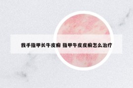 我手指甲長牛皮癬 指甲牛皮皮癬怎么治療