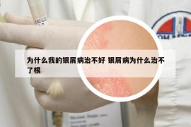 為什么我的銀屑病治不好 銀屑病為什么治不了根
