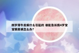 四歲得牛皮癬什么引起的 誰(shuí)能告訴我4歲寶寶銀屑病怎么辦?