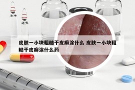 皮膚一小塊粗糙干皮癬涂什么 皮膚一小塊粗糙干皮癬涂什么藥