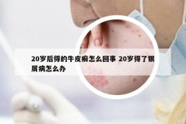 20歲后得的牛皮癬怎么回事 20歲得了銀屑病怎么辦