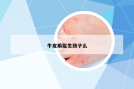牛皮癬能生孩子么